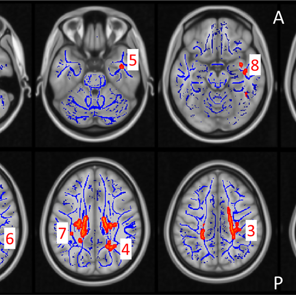 Fried Brains: The Chronicles of My Adolescent Addiction